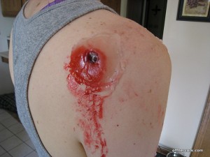 Entry wound 